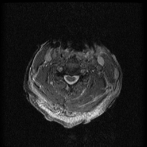 File:Cervical canal stenosis with cord compression (Radiopaedia 34114-35374 Axial Gradient Echo 51).png