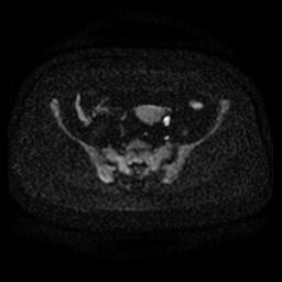 File:Cervical carcinoma (Radiopaedia 67644-77047 Axial DWI 6).jpg