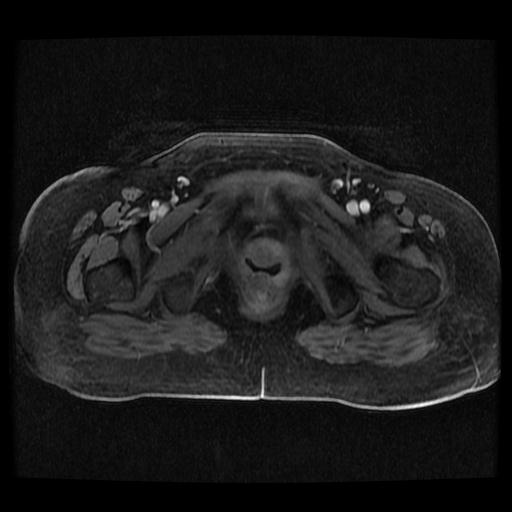 Cervical carcinoma (Radiopaedia 70924-81132 Axial T1 C+ fat sat 204).jpg