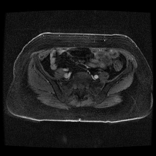 Cervical carcinoma (Radiopaedia 70924-81132 Axial T1 C+ fat sat 250).jpg