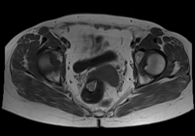 File:Cervical carcinoma (Radiopaedia 88312-104943 Axial T1 14).jpg