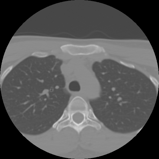 Cervical rib (Radiopaedia 71110-81363 Axial non-contrast 64).jpg