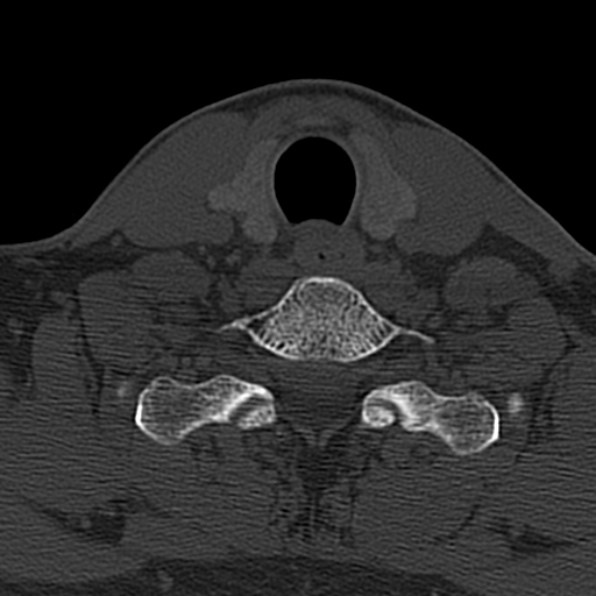 Cervical spondylodiscitis (Radiopaedia 28057-29489 Axial bone window 63).jpg