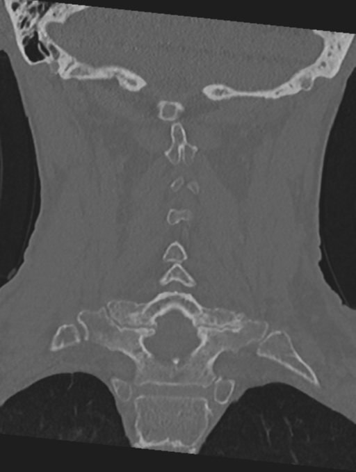 Cervical spondylolysis (Radiopaedia 49616-54811 Coronal bone window 34).png