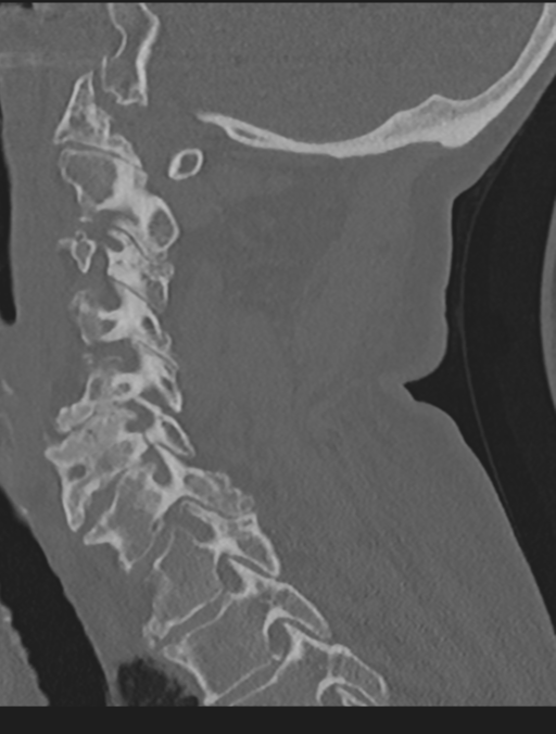 Cervical spondylolysis (Radiopaedia 49616-54811 Sagittal bone window 45).png