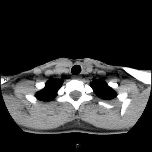 Cervical thymic cyst (Radiopaedia 88632-105335 Axial non-contrast 33).jpg
