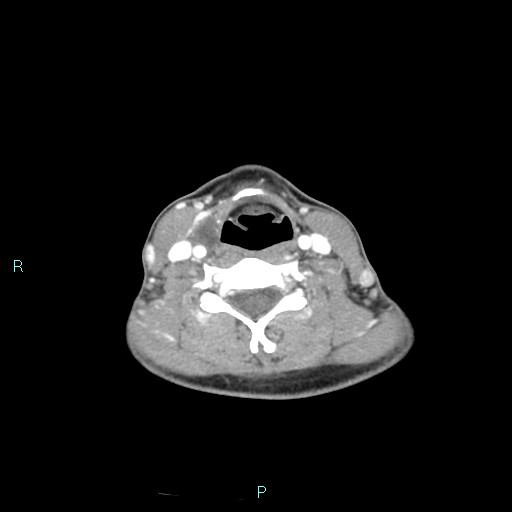 Cervical thymic cyst (Radiopaedia 88632-105335 B 53).jpg