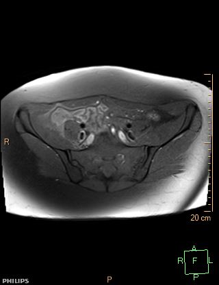 File:Cesarian scar endometriosis (Radiopaedia 68495-78066 Axial T1 fat sat 3).jpg