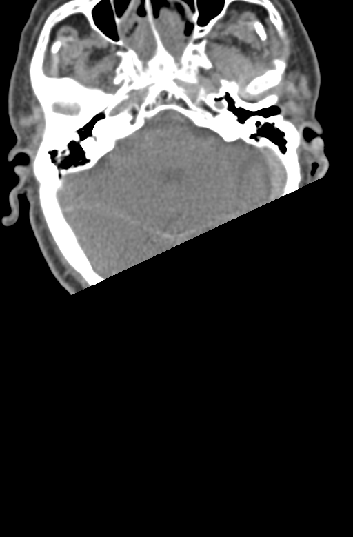 Chalk stick fracture (Radiopaedia 57948-64928 Axial non-contrast 4).png