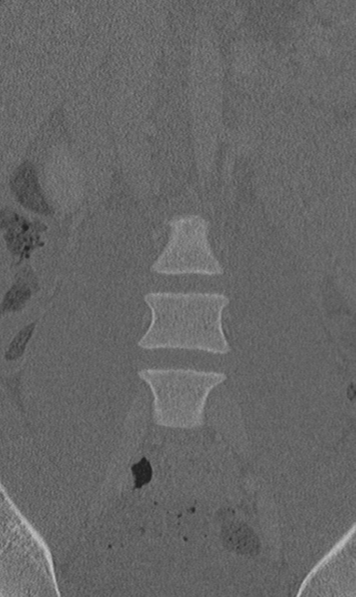 Chance fracture (Radiopaedia 40360-42912 Coronal bone window 15).png