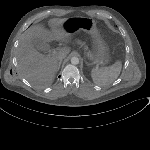 File:Chest multitrauma - aortic injury (Radiopaedia 34708-36147 A 286).png