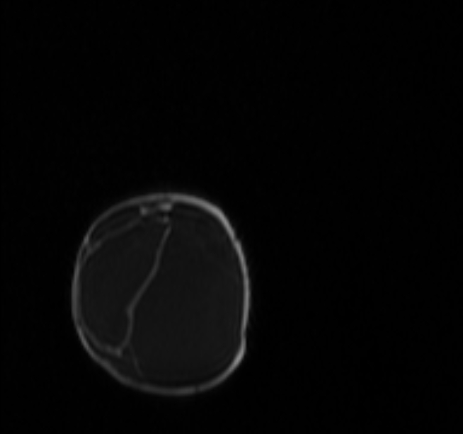Chiari III malformation with occipital encephalocele (Radiopaedia 79446-92559 Coronal T1 C+ mpr 69).jpg