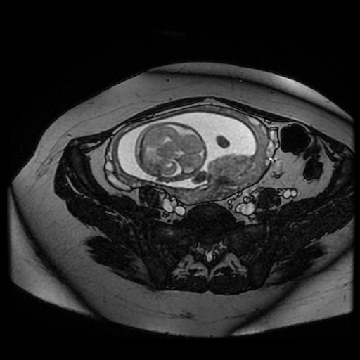 Chiari II malformation - fetal MRI (Radiopaedia 68099-77581 Axial Fiesta 36).jpg