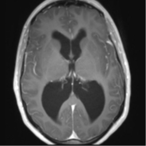 File:Chiari I malformation and obstructive hydrocephalus (Radiopaedia 41185-43978 Axial T1 C+ 17).png