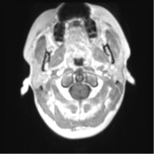 File:Chiari I malformation and obstructive hydrocephalus (Radiopaedia 41185-43978 Axial T1 C+ 3).png