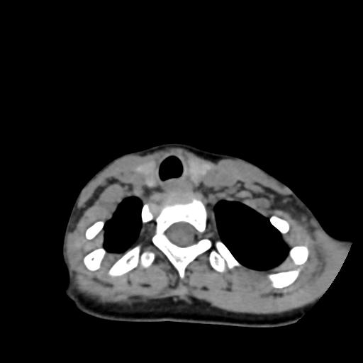 Chiari I with syrinx and skull base anomalies (Radiopaedia 89444-106412 Axial non-contrast 122).jpg