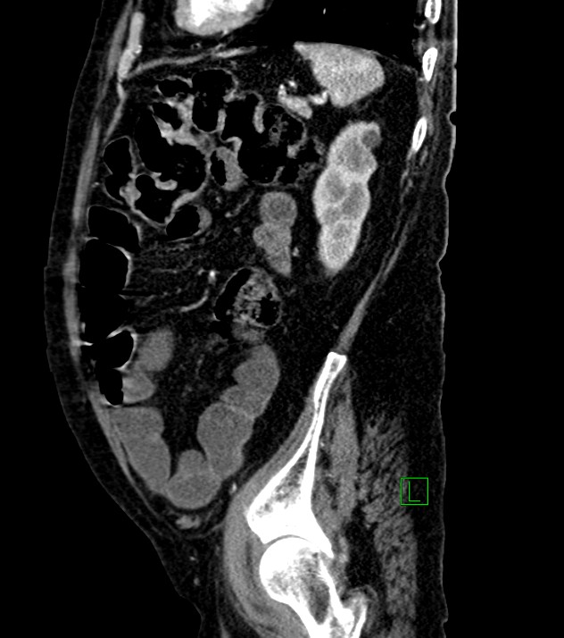 Cholangiocarcinoma with cerebral metastases (Radiopaedia 83519-98629 F 33).jpg