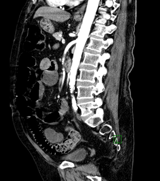 Cholangiocarcinoma with cerebral metastases (Radiopaedia 83519-98629 F 56).jpg
