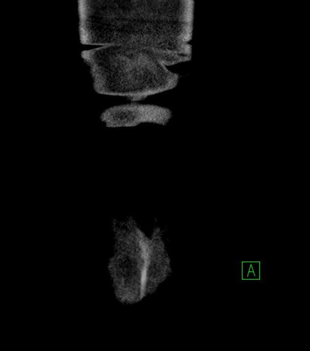 Cholangiocarcinoma with cerebral metastases (Radiopaedia 83519-98629 G 86).jpg