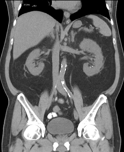 Cholecystitis with focal perforation and hepatic abscess (Radiopaedia 37189-38945 Coronal non-contrast 33).png