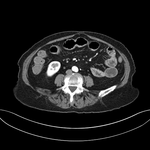 Cholecystoduodenal fistula due to calculous cholecystitis with gallstone migration (Radiopaedia 86875-103077 A 42).jpg