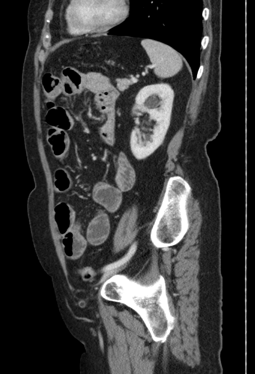Cholecystoduodenal fistula due to calculous cholecystitis with gallstone migration (Radiopaedia 86875-103077 F 17).jpg