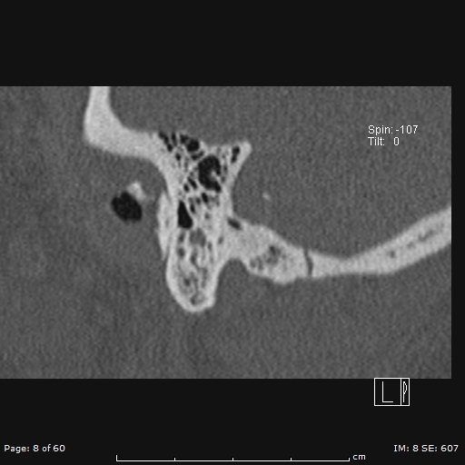 Cholesteatoma - external auditory canal (Radiopaedia 88452-105096 Sagittal bone window 8).jpg
