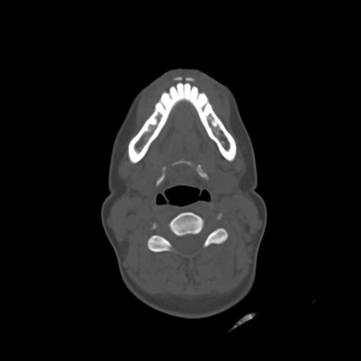 File:Chondroblastic osteosarcoma (Radiopaedia 67363-76741 Axial bone window 19).jpg