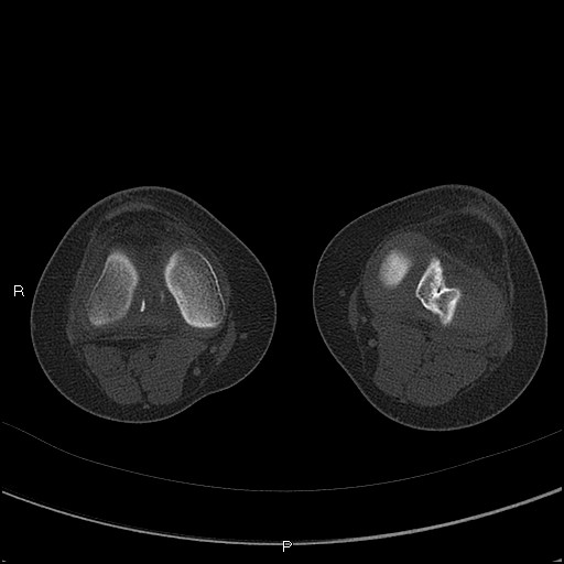 Chondroblastoma (Radiopaedia 62721-71030 Axial bone window 34).jpg