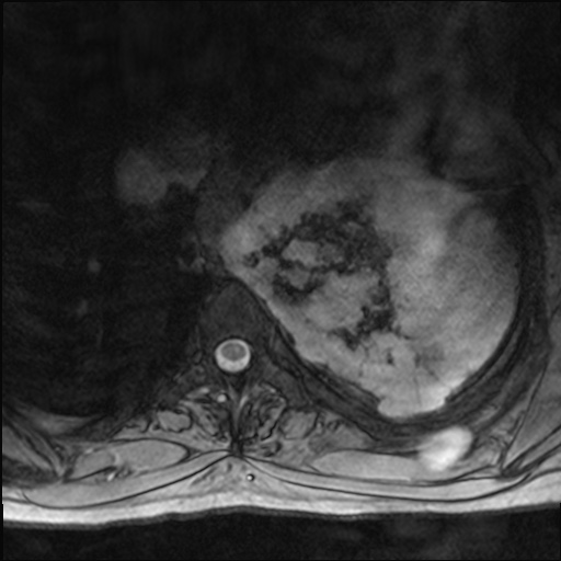 File:Chondrosarcoma - chest wall (Radiopaedia 65192-74200 Axial Gradient Echo 26).jpg