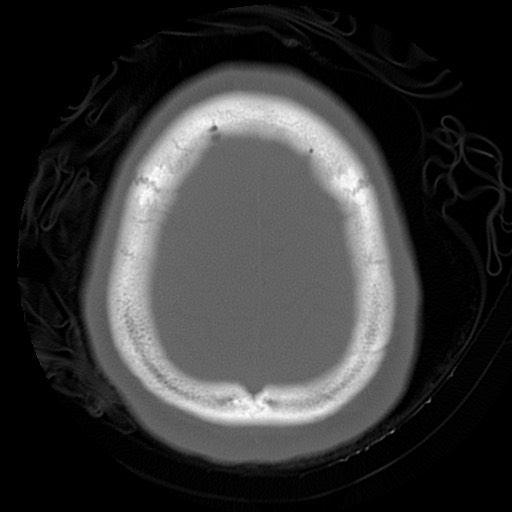 File:Chondrosarcoma - sphenoid wing (Radiopaedia 58259-67828 Axial bone window 25).jpg