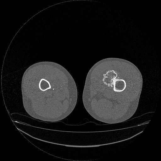 File:Chondrosarcoma arising from exostosis (Radiopaedia 59996-67507 Axial bone window 15).jpg