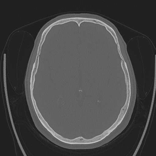 Chondrosarcoma of skull base- grade II (Radiopaedia 40948-43653 Axial bone window 24).png