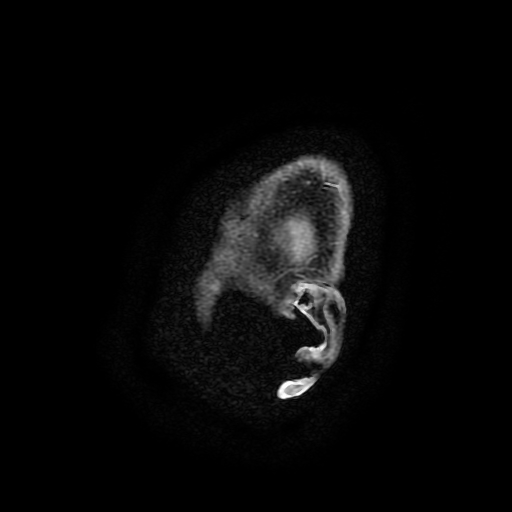 File:Chordoid glioma of third ventricle (Radiopaedia 91612-109340 F 204).jpg