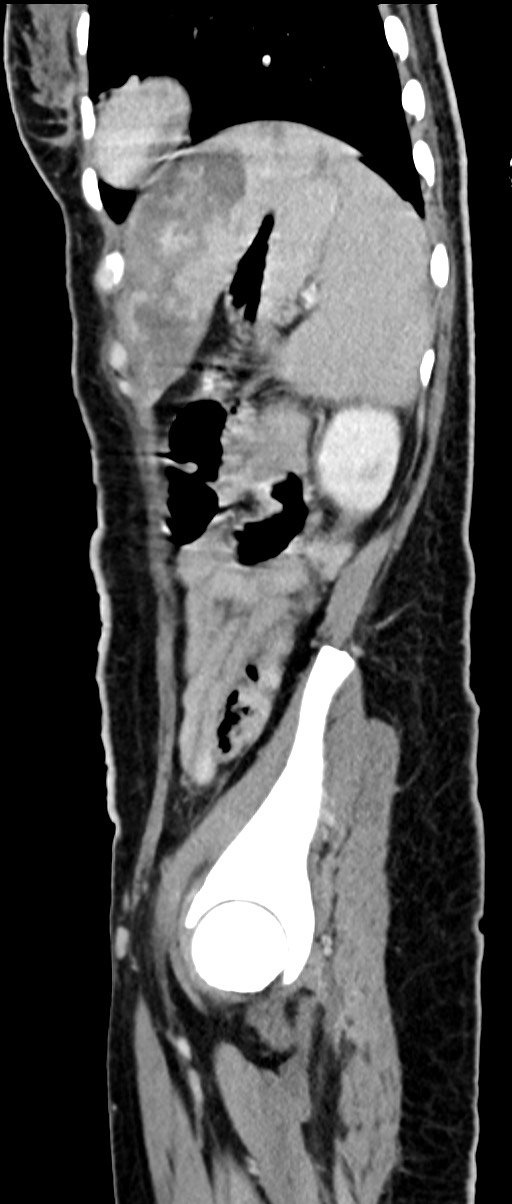 Choriocarcinoma liver metastases (Radiopaedia 74768-85766 C 61).jpg