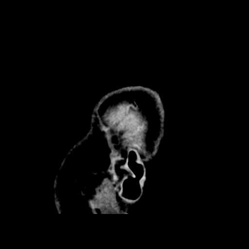 Choroid plexus papilloma (Radiopaedia 34951-36436 C 58).png