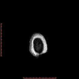 Choroid plexus xanthogranuloma (Radiopaedia 67843-77270 Axial T1 14).jpg