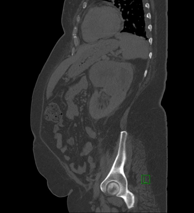 Chromophobe renal cell carcinoma (Radiopaedia 84239-99519 Sagittal bone window 32).jpg