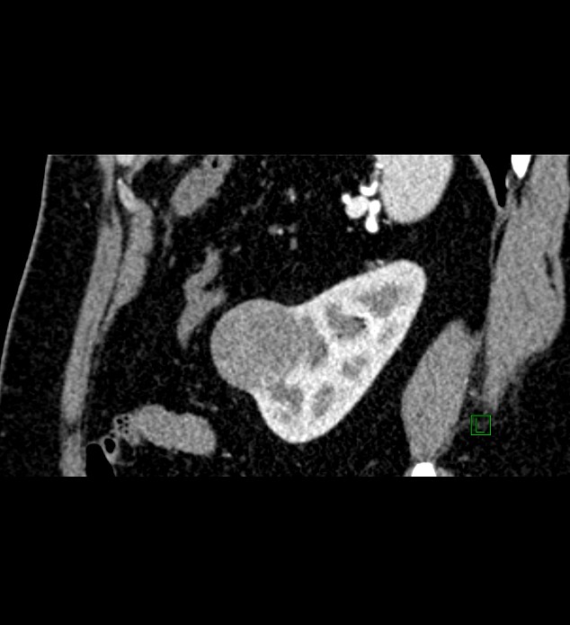 Chromophobe renal cell carcinoma (Radiopaedia 84286-99573 F 37).jpg