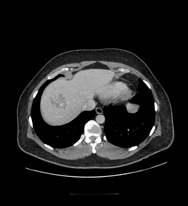 Chromophobe renal cell carcinoma (Radiopaedia 84337-99644 C 17).jpg