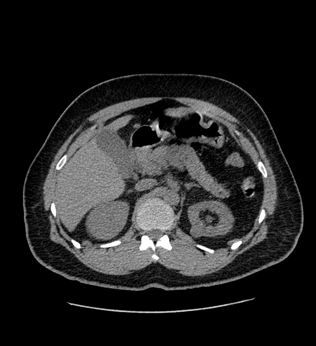 Chromophobe renal cell carcinoma (Radiopaedia 84337-99693 Axial non-contrast 41).jpg