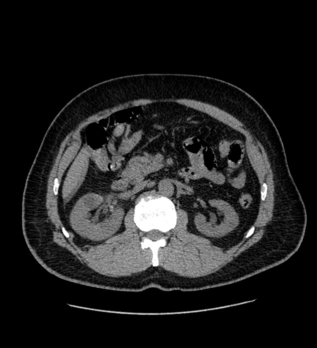 Chromophobe renal cell carcinoma (Radiopaedia 84337-99693 Axial non-contrast 52).jpg