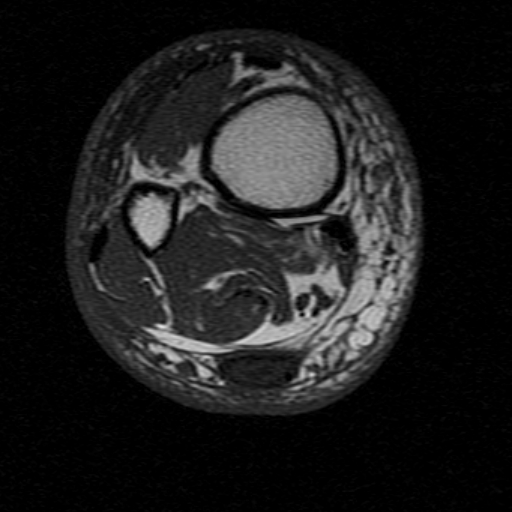 File:Chronic Achilles tendon rupture (Radiopaedia 15262-15100 Axial T1 1).jpg