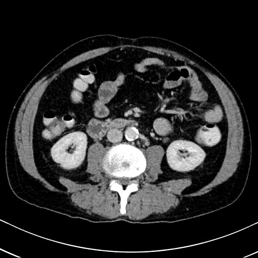 Chronic appendicitis complicated by appendicular abscess, pylephlebitis and liver abscess (Radiopaedia 54483-60700 B 81).jpg