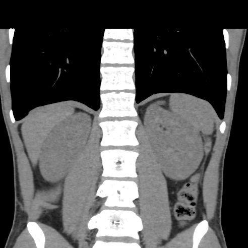File:Chronic calcific pancreatitis (Radiopaedia 56280-62953 Coronal non-contrast 27).jpg