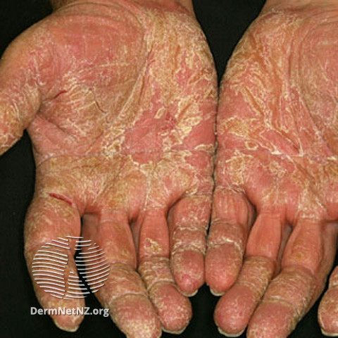 File:Chronic eczema (DermNet NZ scaly-s-acquired-kd2).jpg