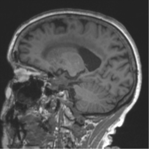 Chronic hypertensive encephalopathy (Radiopaedia 39993-42482 Sagittal T1 39).png