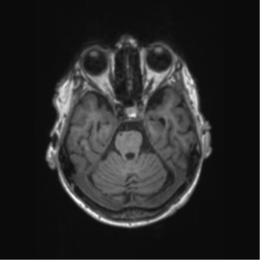 File:Chronic hypertensive encephalopathy (Radiopaedia 72844-83495 Axial T1 50).png