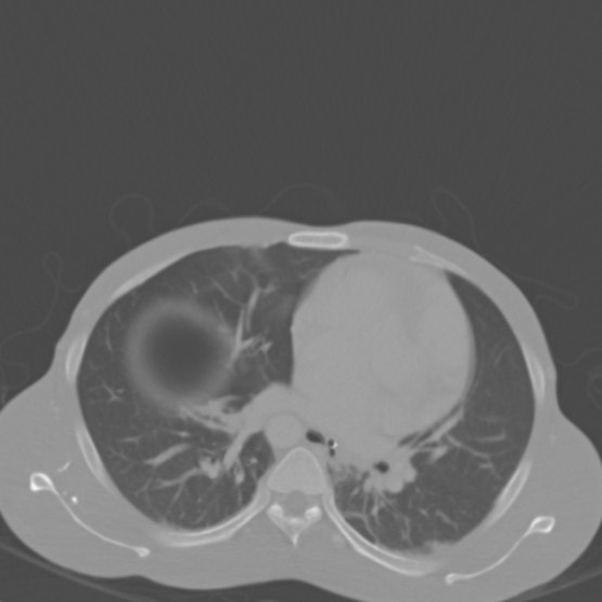Chronic large bowel pseudo-obstruction (Radiopaedia 43181-46492 Axial bone window 15).jpg