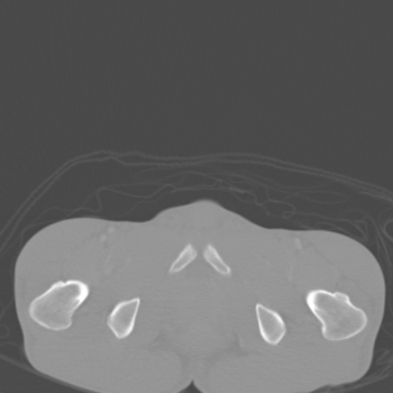 Chronic large bowel pseudo-obstruction (Radiopaedia 43181-46492 Axial bone window 165).jpg